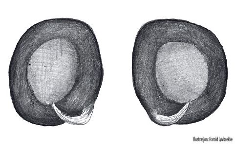 Datei:Misumena vatia vulva do HLovbrekke.jpg