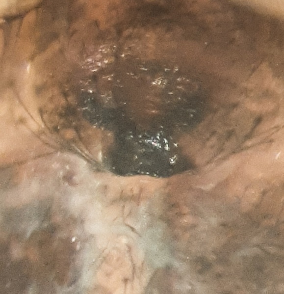 Datei:Enoplognatha quadripunctata f epigyne.jpg